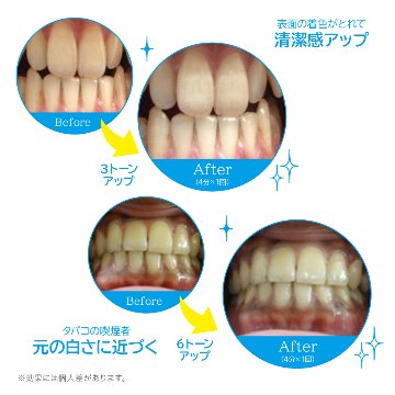 DR歯APPY　16LEDマウスピース&液体歯みがきセット画像